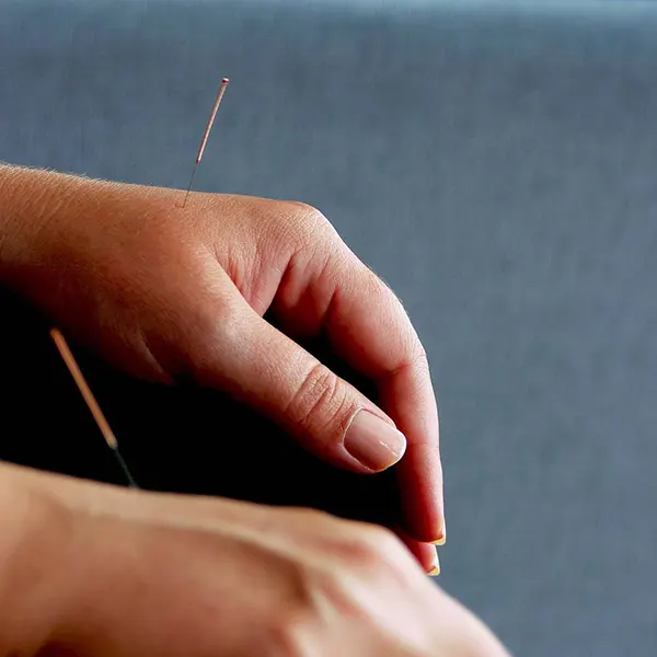 Best Acupuncture Therapy Near Me in Anaheim, CA. Acupuncture for Pain Relief.